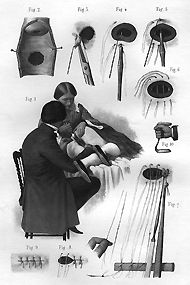 J. Marion Sims repairing a vesico-vaginal fistula with silver wire sutures. 1870. Plate XIV from Henry Savage's The surgery, surgical pathology and surgical anatomy of the female pelvic organs, 2nd edition, 1870.