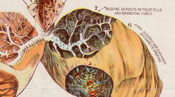 Scientific drawings of the tobacco related diseases effects on the human organs.