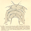 Nineteenth century illustration detailing the peritoneal and hepatic pouches and ensiform cartilages in the connecting band of Chang and Eng Bunker.